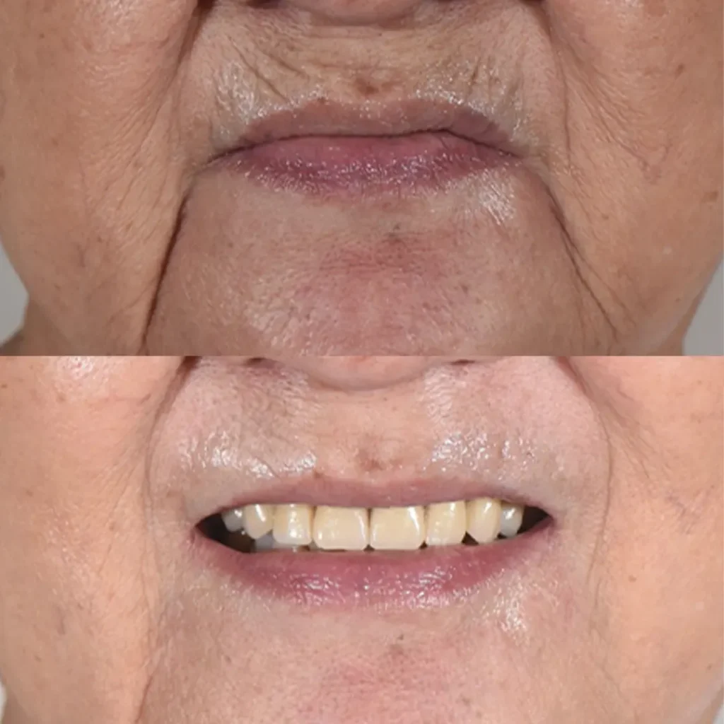 denture_2