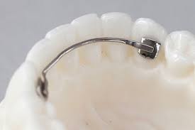 Retainer Gigi