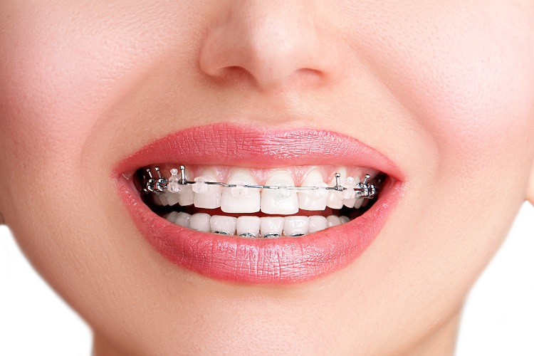 Behel Self Ligating