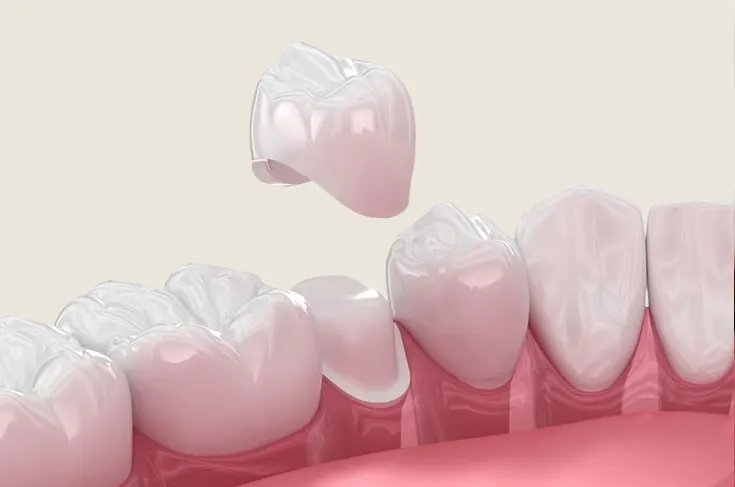 Mengenal Crown Gigi: Fungsi, Jenis, Prosedur, dan Biaya