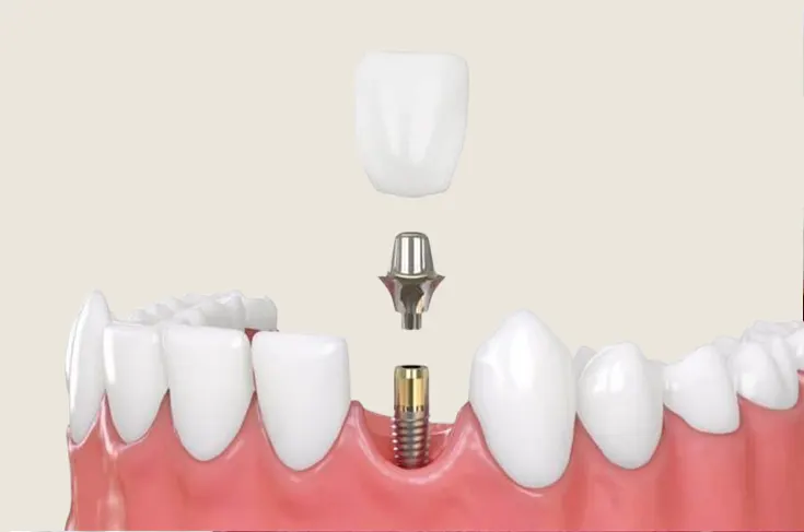 Implant