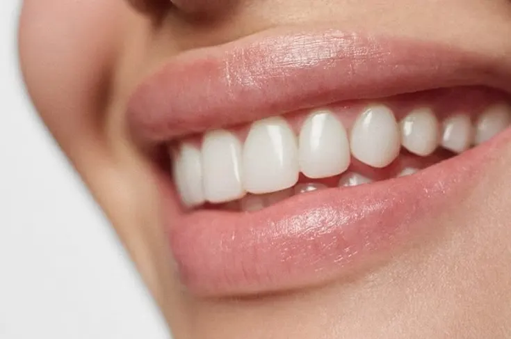Veneer