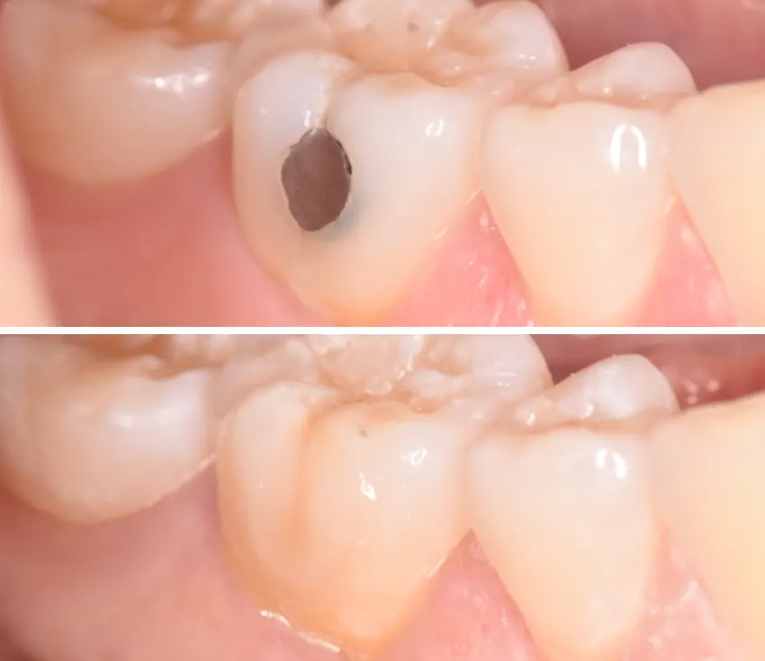filling_4