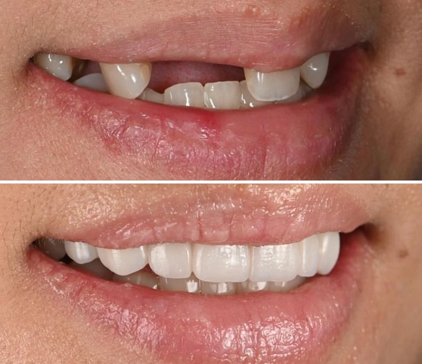 implant1