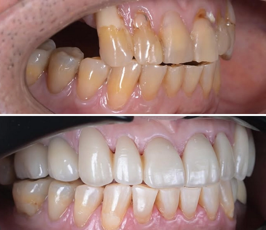 implant2