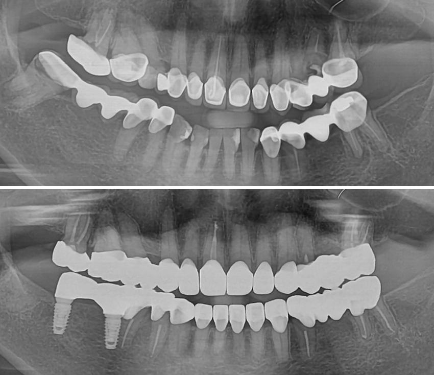 implant3