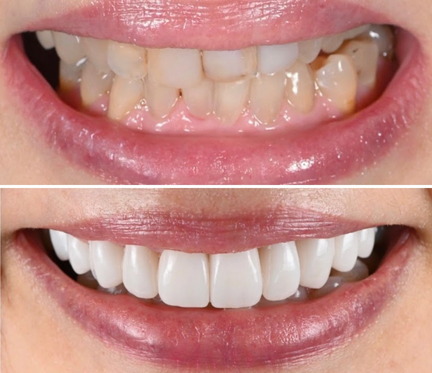 veneer