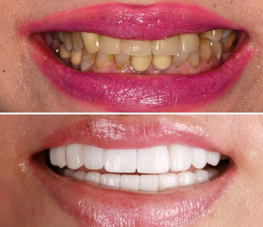 veneer2
