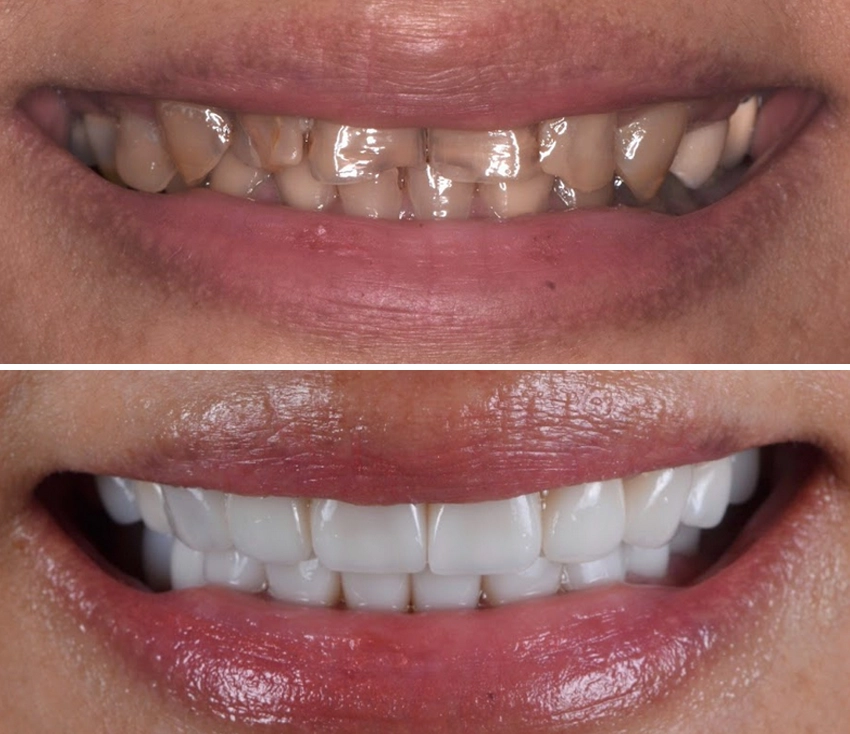 veneer3