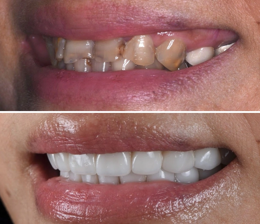 veneer5