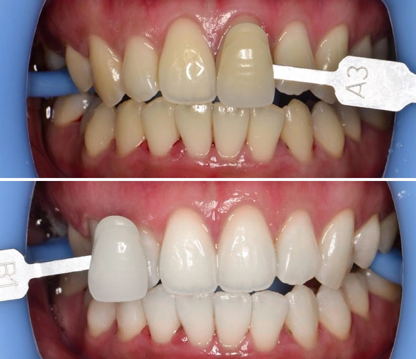 whitening3