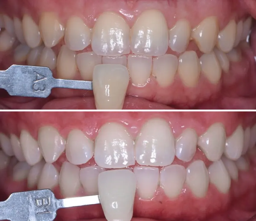 whitening4