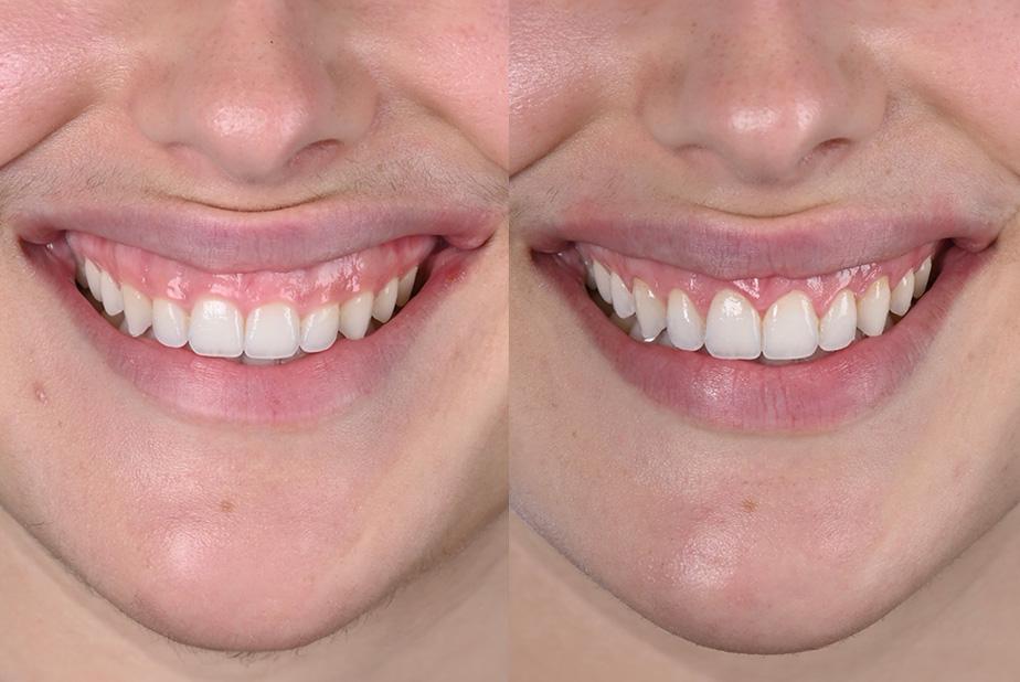 gummy smile