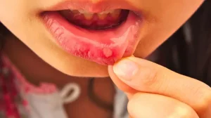 obat sariawan paling ampuh
