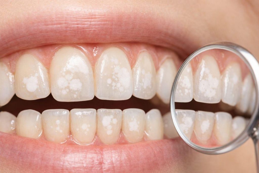 tooth mousse
