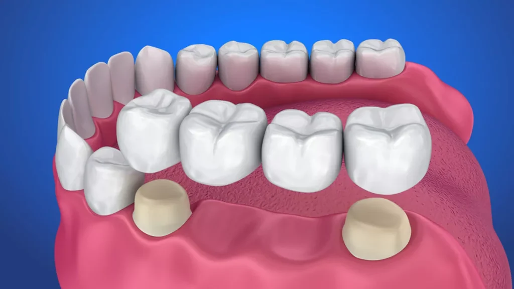 Bridge dan Crown Gigi: Perbedaan, Kelebihan, dan Mana yang Lebih Baik