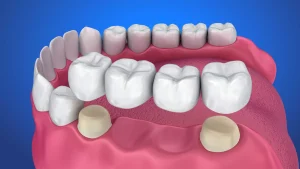 Bridge dan Crown Gigi: Perbedaan, Kelebihan, dan Mana yang Lebih Baik