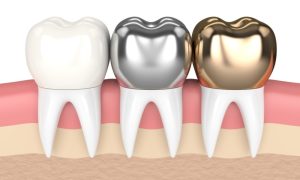 Jenis Crown Gigi, Panduan Lengkap Memilih Material yang Tepat