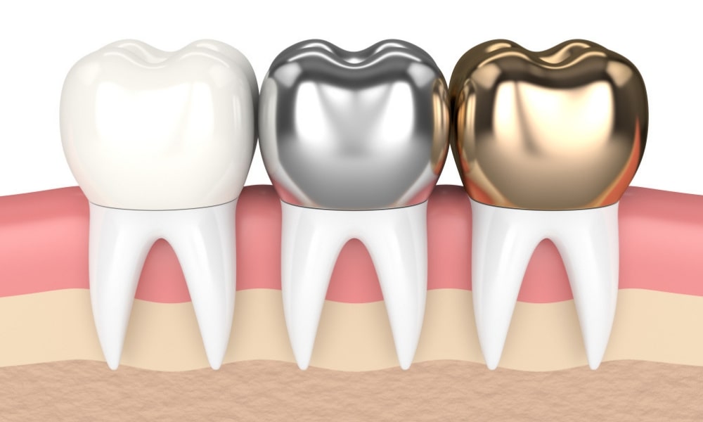 Jenis Crown Gigi, Panduan Lengkap Memilih Material yang Tepat