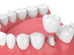 Crown Gigi: Fungsi, Jenis, dan Prosedurnya