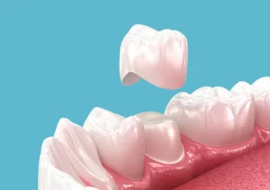 Pemasangan Crown Gigi: Prosedur Lengkap, Jenis, dan Perawatannya